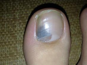 导致灰指甲的病因有哪些